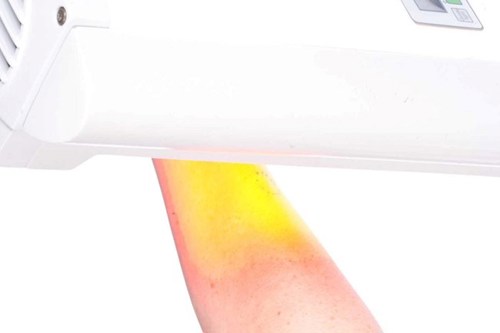 Photodynamic therapy (PDT) arm treatment